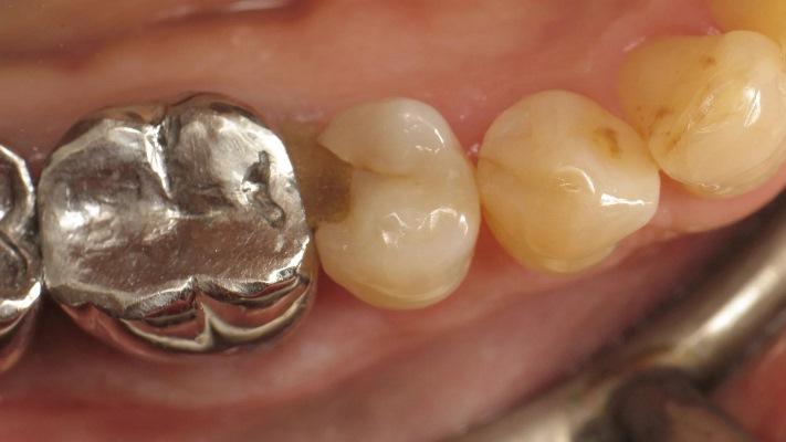 Реставрация II класса с использованием термовязкого композита