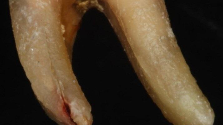 Применение флуоресцентных ламп для определения бактерий в трещинах корня зуба