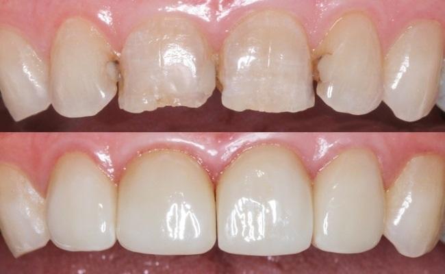 7 советов для прямой реставрации фронтальной группы зубов