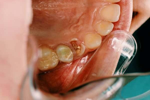 Реставрация зуба 1.6 у ребенка 12 лет