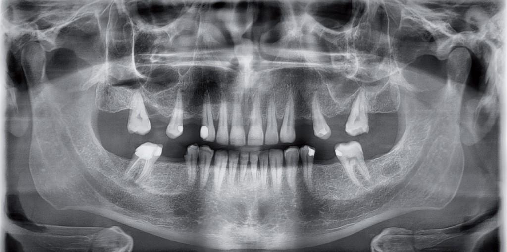Эмфизема лица при лечении зубов