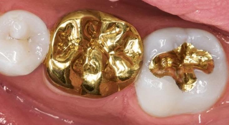 Редкий красный плоский лишай полости рта может быть следствием ношения золотых зубных коронок