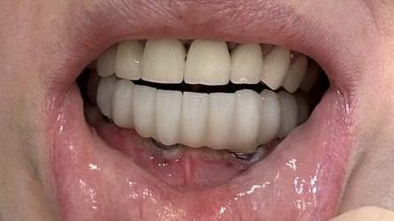 Как правильно пользоваться фиксирующим кремом для зубных протезов?
