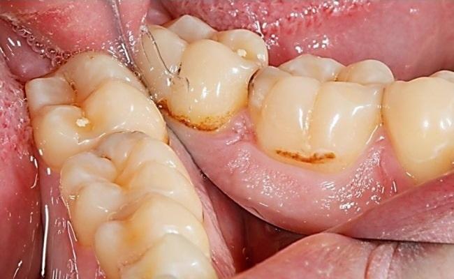 Инвазивный подход в лечении зубов