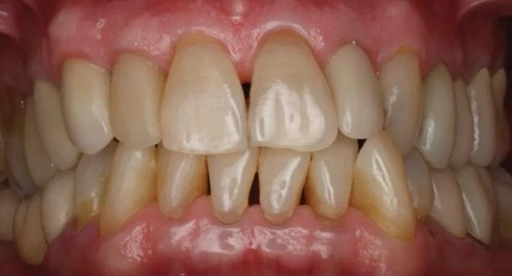 Лечение двух комбинированных терапевтических показаний одним биоматериалом