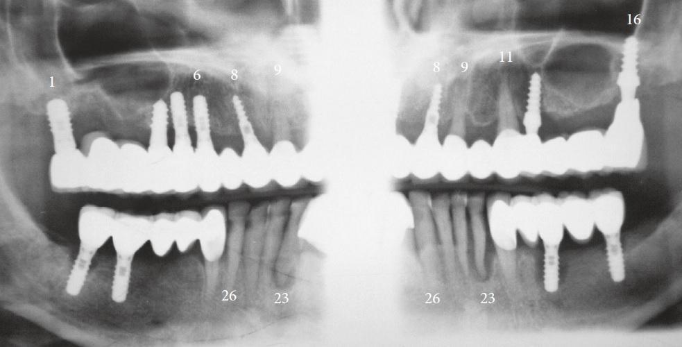 Восстановление костной ткани зубов. Костная резорбция челюсти. Хондрома верхней челюсти. Восстановление кости челюсти. Деструкция костной ткани челюсти.