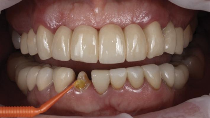 Новые веяния в адгезивных технологиях: использование универсального композитного цемента в неидеальных ситуациях при протезировании зубов