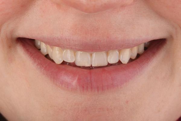 Форма зубов клыки. Зубы с удлиненными клыками.