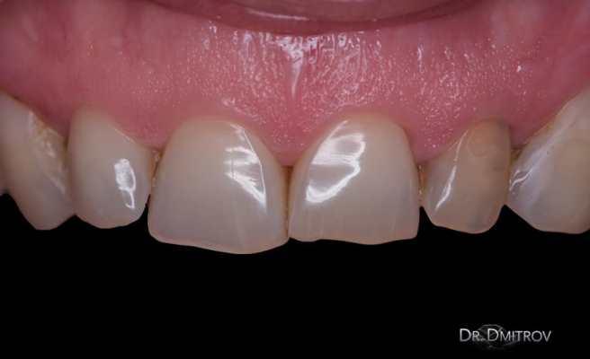 Компромиссная реставрация зуба 2.2 после эндо лечения