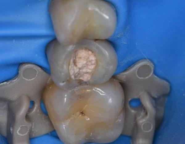 Замена реставрации 1.4 зуба, восстановление на СВШ 1.5 зуба и лечение кариеса 1.6 зуба