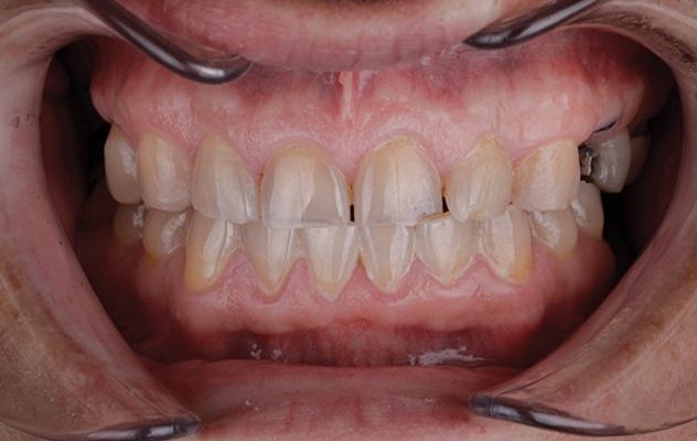 Системный подход к тотальной реабилитации сложного случая деформации зубных дуг с использованием цифровых технологий в рабочем процессе и надлежащей изоляции полости рта