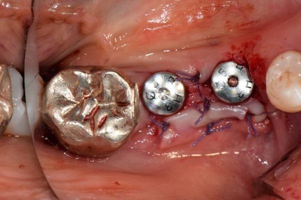 Установка имплантатов Osstem в сочетании с направленной костной регенерацией (методика «сэндвич»)