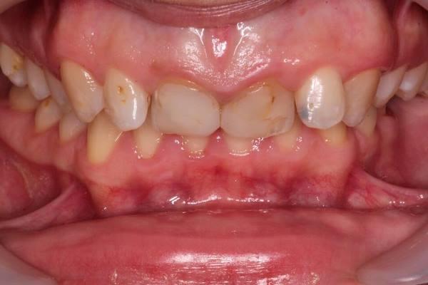 Изменение формы и положения зубов при помощи коронок E.max