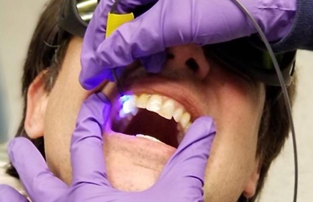 Исследователи представляют новое устройство для измерения кислотности зубной биопленки