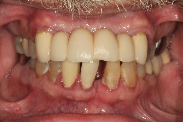 Протоколы тотального протезирования зубных дуг при помощи съёмных конструкций с опорой на дентальные имплантаты