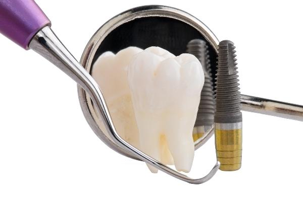 Способ улучшения биосовместимости стоматологических имплантатов