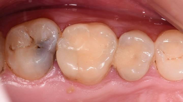 Лечение вторичного кариеса и прямая реставрация жевательных зубов