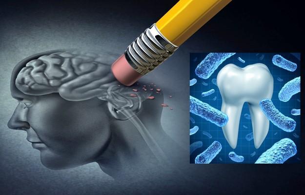 Две новости, касающиеся заболеваний десен и мозга: плохая и хорошая
