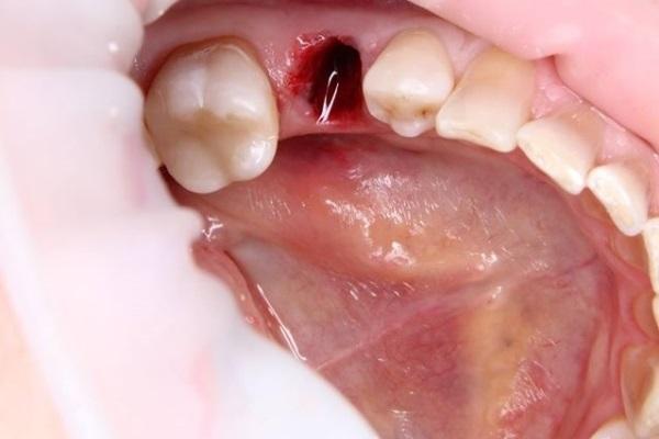 Герметизация лунки удалённого зуба