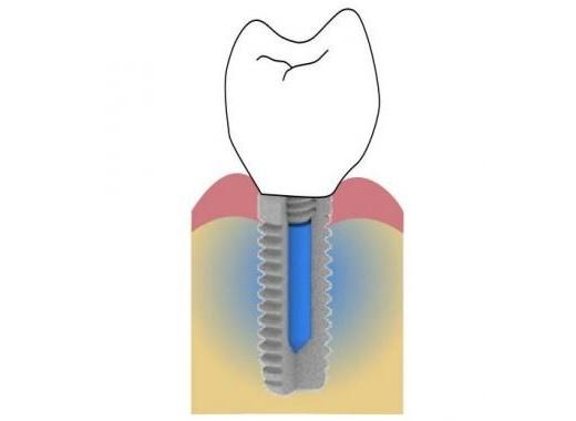 Разработали зубной имплантат с резервуаром для медленного высвобождения противовоспалительных препаратов