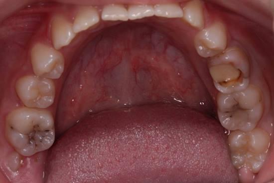 Применение силиконового шаблона в ежедневной практике врача-стоматолога терапевта