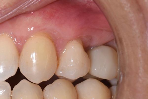 Пластиĸа мягĸих тĸаней в области имплантата и зубов
