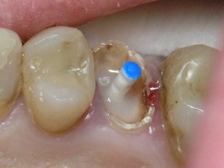 Оптимизация восстановления тела зуба и реставрации на штифте