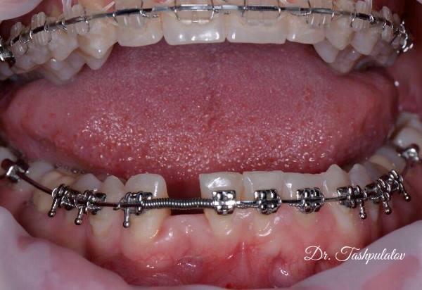 Имплантация 42 зуба в процессе ортодонтического лечения
