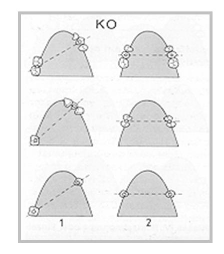 Группа КО (противопоказаний) к коническим телескопическим коронкам в зависимости от направления линии, соединяющей опорные зубы: 1- диагональное направление; 2- поперечное направление.