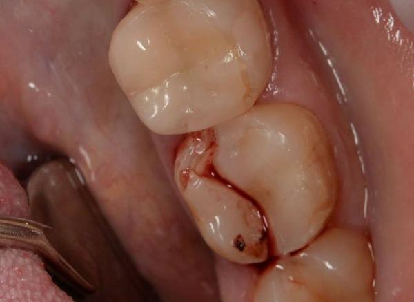 Применение концепции BOPT для спасения зуба