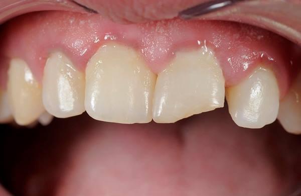 Реконструкция травматического повреждения режущего края 21 зуба