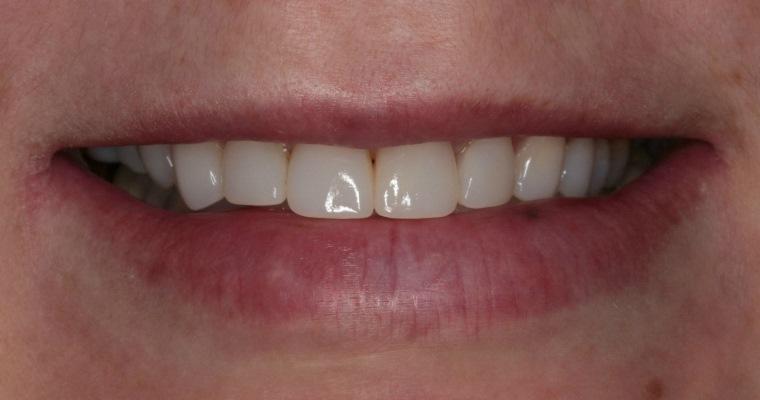 Увеличение объемов зубов для улучшения эстетики