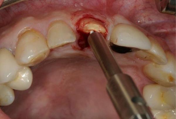 Сохранение объема лунки зуба гранулированным дентином (серия клинических случаев)