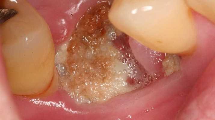 Разработали способ лечения остеонекроза челюсти после зубной имплантации с помощью гормонального препарата