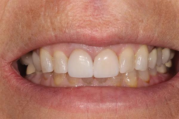 За пределами реставрации отдельных зубов: системный подход к полной реабилитации зубочелюстной системы