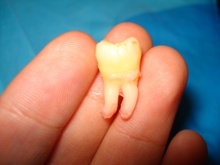 удаленный зуб