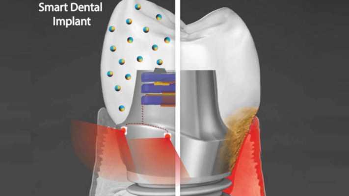 Исследователи разрабатывают антибактериальный умный зубной имплантат, который использует фототерапию