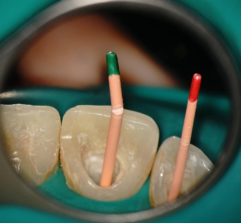 Сколько ходят с лекарством в зубе. Эндодонтия в стоматологии. Пломбирование каналов зубов.