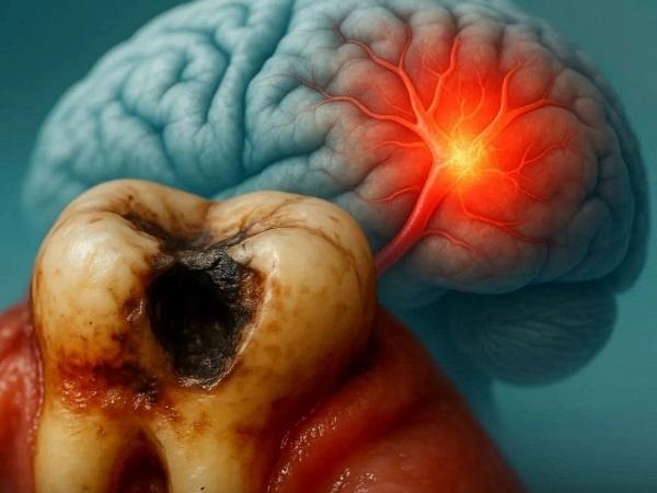 Кариес, заболевания десен могут быть связаны с повышенным риском инсульта