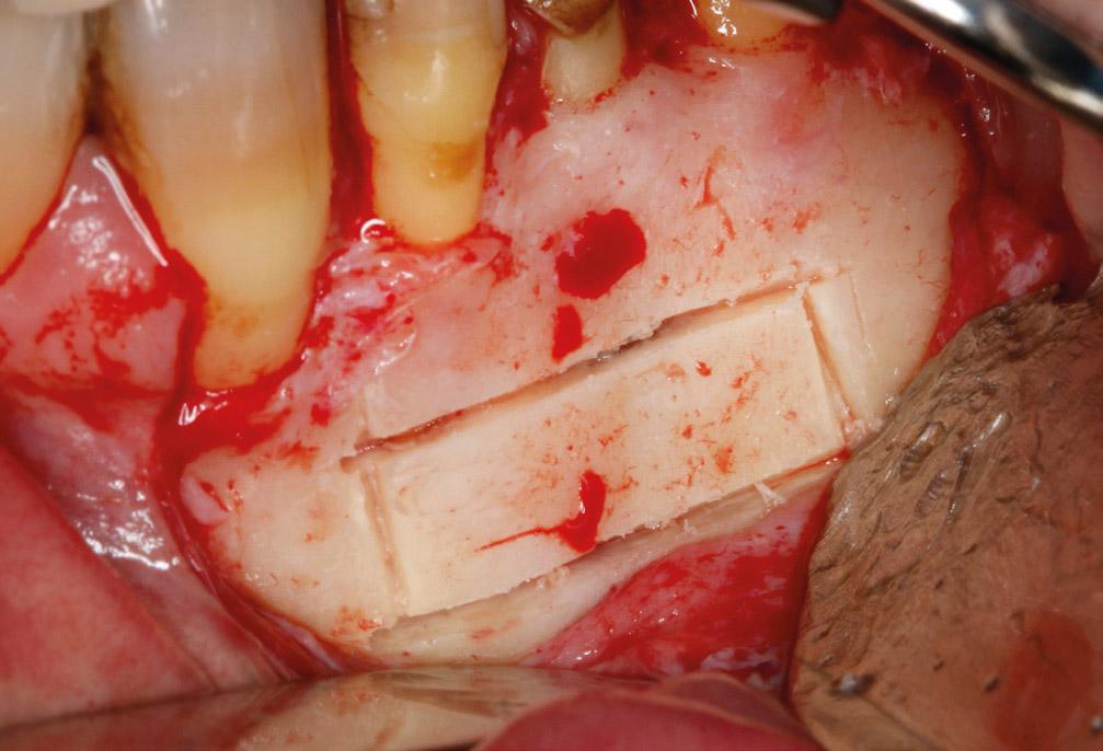 Периапикальное хирургическое лечение зубов