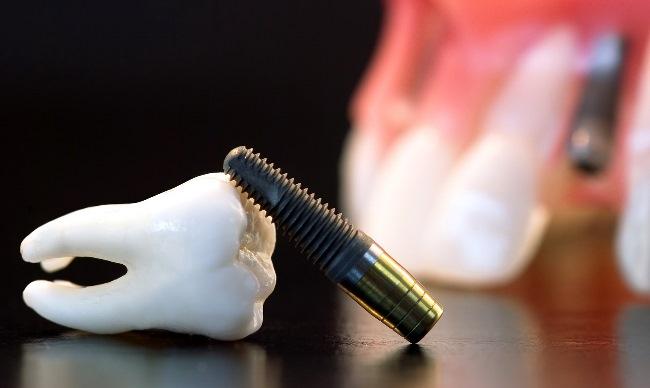 Пептид, содержащийся в слюне, может способствовать более быстрой интеграции зубного имплантата
