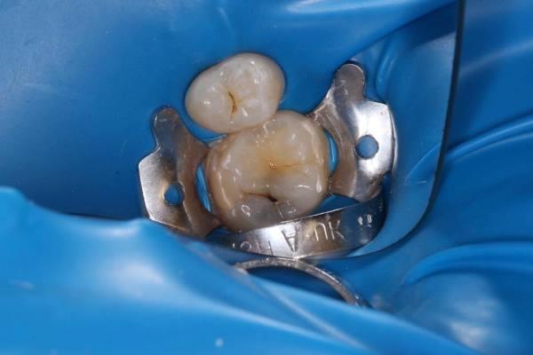 Реставрация жевательной поверхности зубов материалом Sapphire