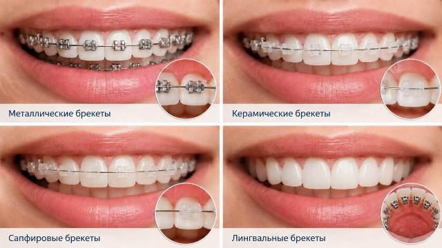 Разновидности брекетов