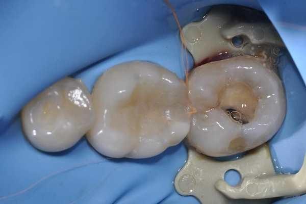 Реставрация зубов 46, 47
