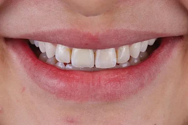 Цифровой дизайн улыбки и изготовление CAD/CAM реставраций в сложном с точки зрения эстетики случае