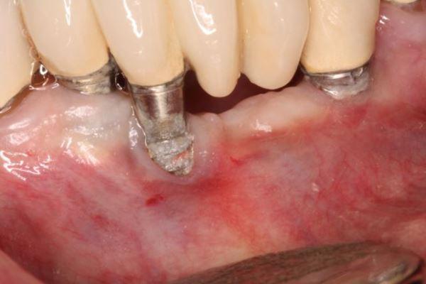 Аллергия на препараты пенициллина может быть маркером осложнений приживаемости зубного имплантата
