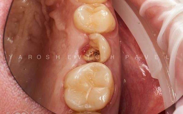 Одномоментная имплантация и немедленная нагрузка в область 1.5 зуба