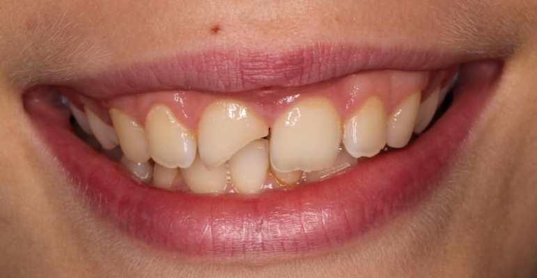 Травма 11 зуба