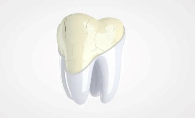 Выявлен механизм, лежащий в основе нарушения состояния зубной эмали у пациентов с целиакией