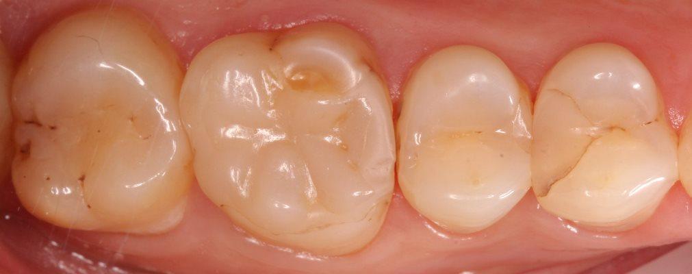 Восстановление жевательных зубов различными методами реставрации